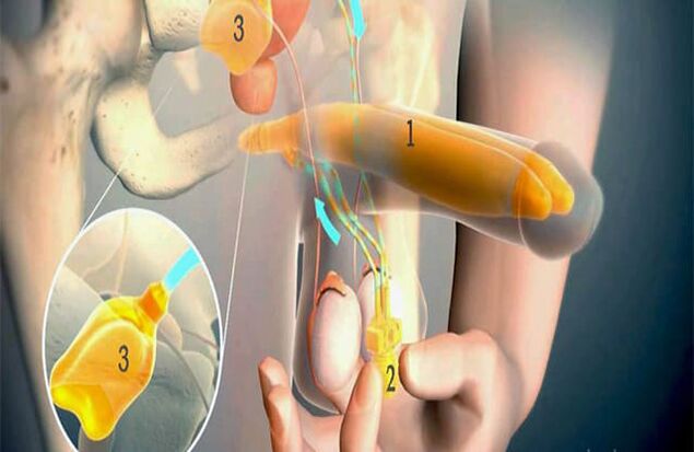 Lipofilling operation
